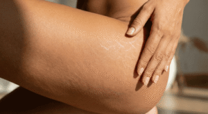 Close-up da coxa e quadril de uma mulher mostrando estrias brancas e prateadas, com uma mão tocando suavemente a pele.